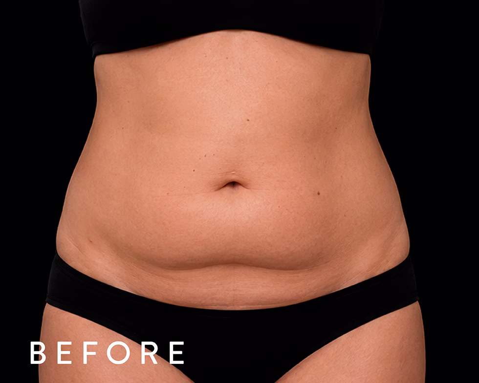 Balmori Center - REDUCIR CELULITIS Y FLACIDEZ BRAZOS, PIERNAS, GLÚTEOS Y ABDOMEN -Radiofrecuencia