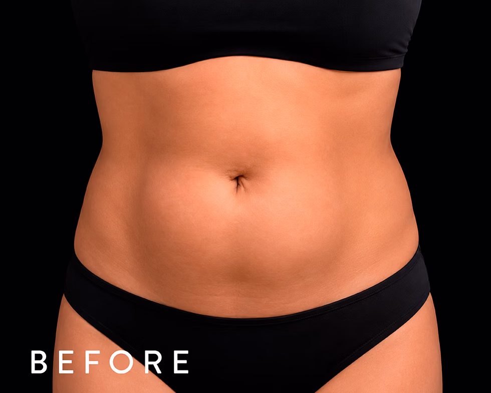 Balmori Center - REDUCIR CELULITIS Y FLACIDEZ BRAZOS, PIERNAS, GLÚTEOS Y ABDOMEN -Radiofrecuencia