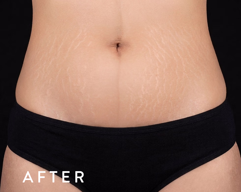 Close-up of a woman's abdomen after a cosmetic treatment, showing smoother skin with faint stretch marks and wearing black underwear.