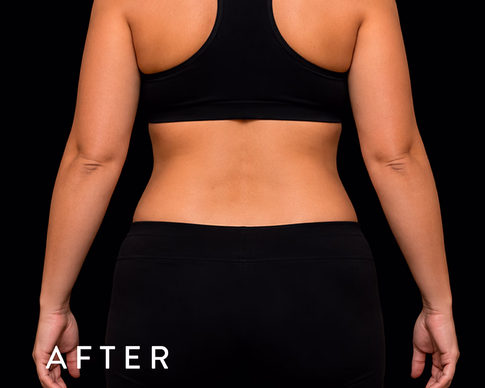 Balmori Center - Servicios - GORDITOS EN ESPALDA Y ABDOMEN - t-shape - RADIOFRECUENCIA CON DRENAJE LINFATICO ACTIVO