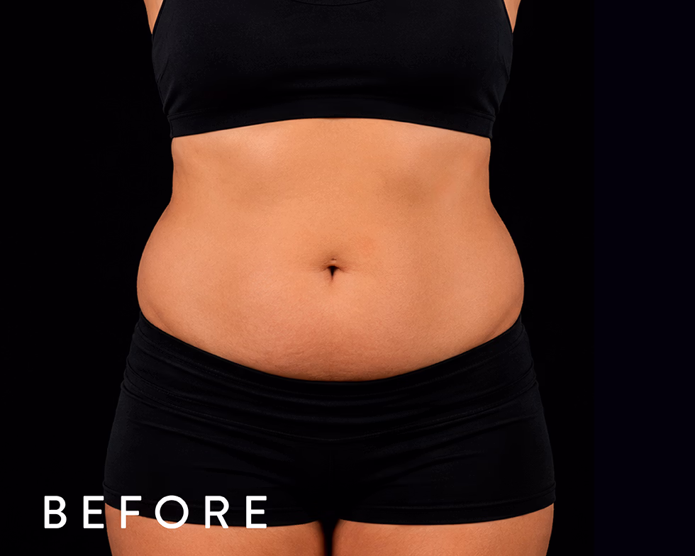 Front view of a woman's midsection in a black sports bra and shorts, showing a fuller abdomen before a fitness program (BEFORE).