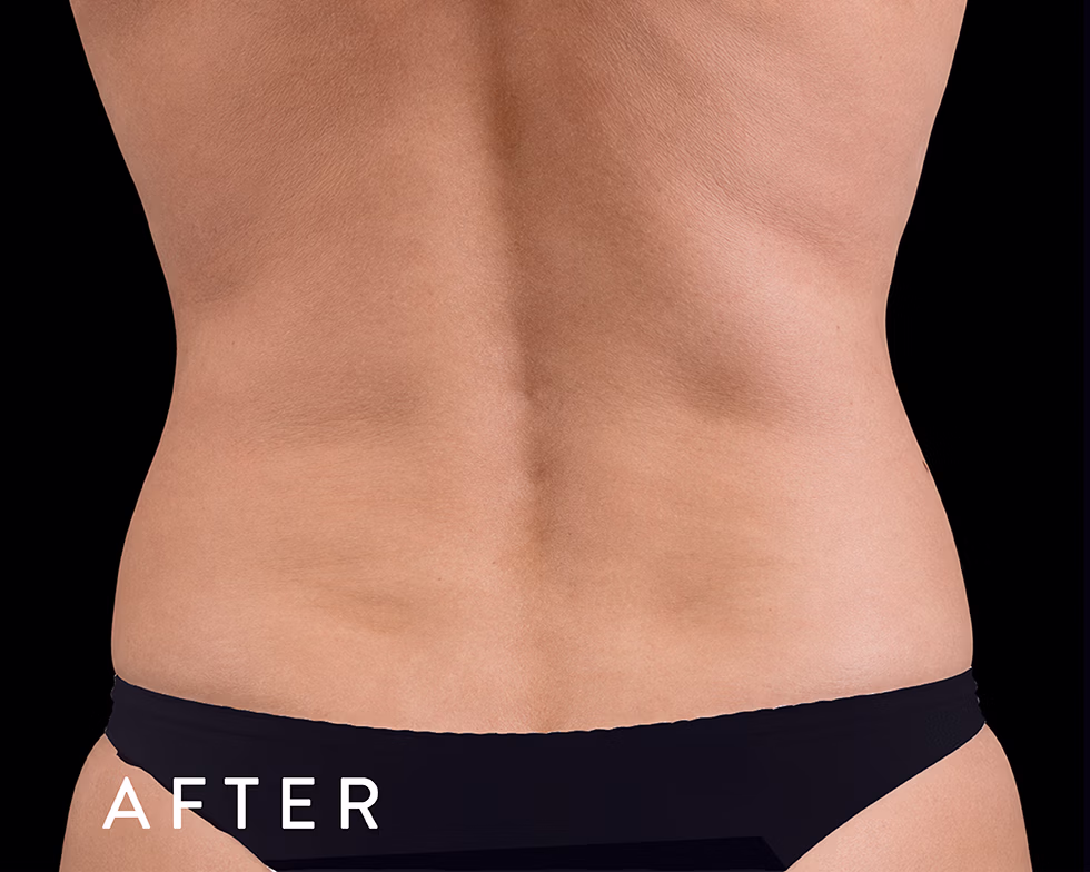 Balmori Center - Servicios - GORDITOS EN ESPALDA Y ABDOMEN - exilis - RADIOFRECUENCIA MONOPOLAR