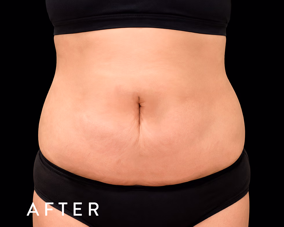 Balmori Center - Servicios - GORDITOS EN ESPALDA Y ABDOMEN - exilis - RADIOFRECUENCIA MONOPOLAR