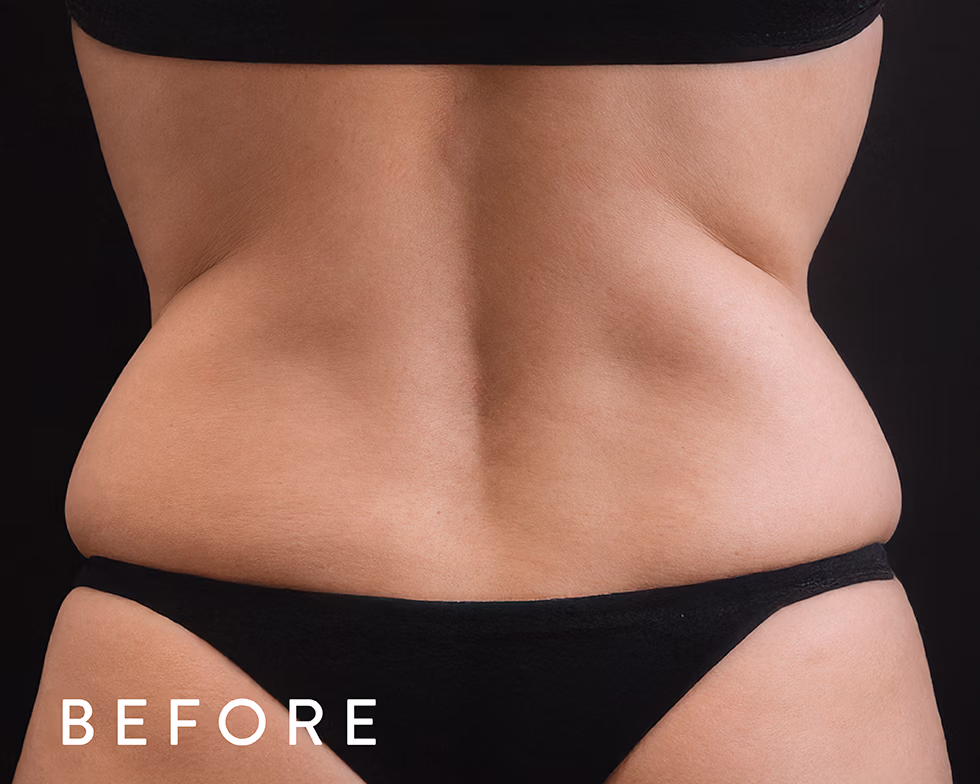 Balmori Center - Servicios - GORDITOS EN ESPALDA Y ABDOMEN - exilis - RADIOFRECUENCIA MONOPOLAR
