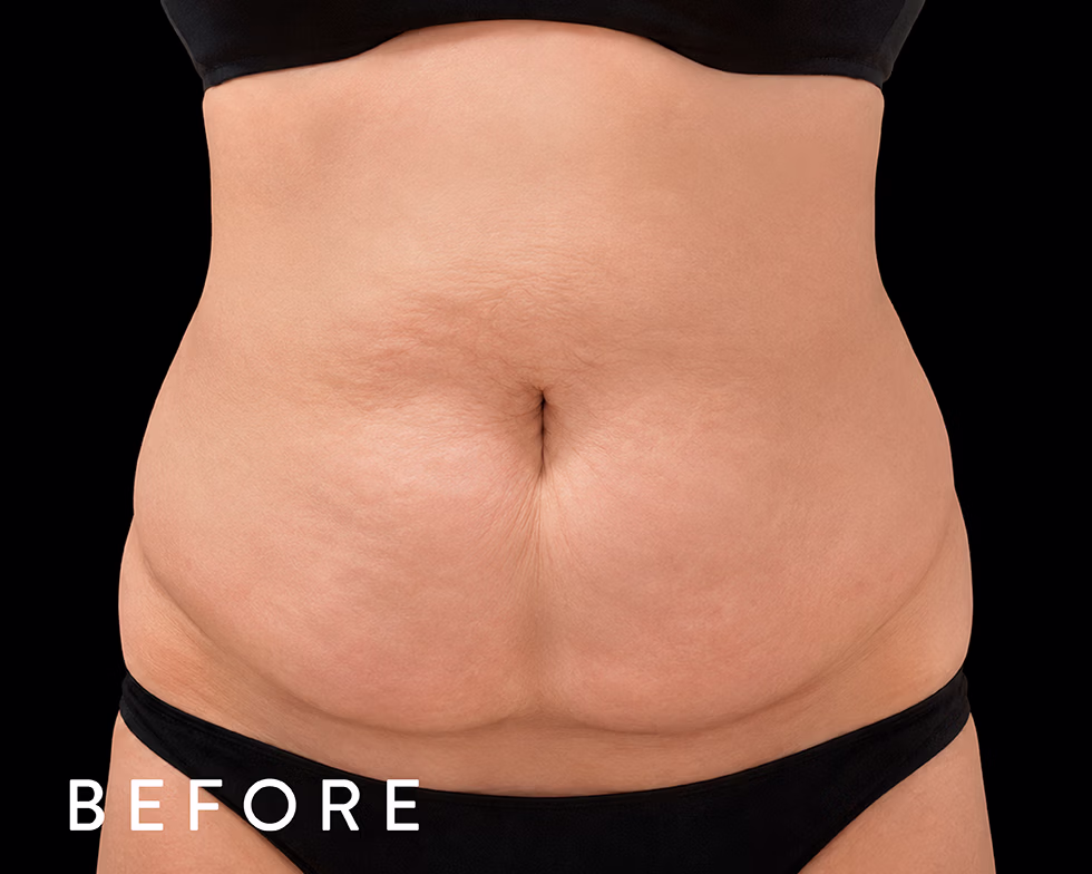 Balmori Center - Servicios - GORDITOS EN ESPALDA Y ABDOMEN - exilis - RADIOFRECUENCIA MONOPOLAR