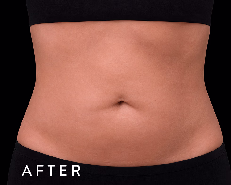 Balmori Center - REDUCIR TALLAS - Ultraformer y Ultherapy - ULTRASONIDO FOCALIZADO DE ALTA INTENSIDAD