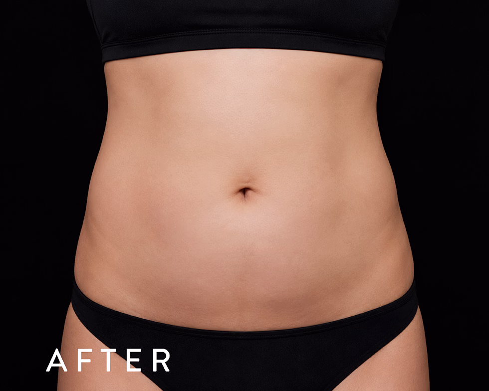 Balmori Center - REDUCIR TALLAS - Ultraformer y Ultherapy - ULTRASONIDO FOCALIZADO DE ALTA INTENSIDAD
