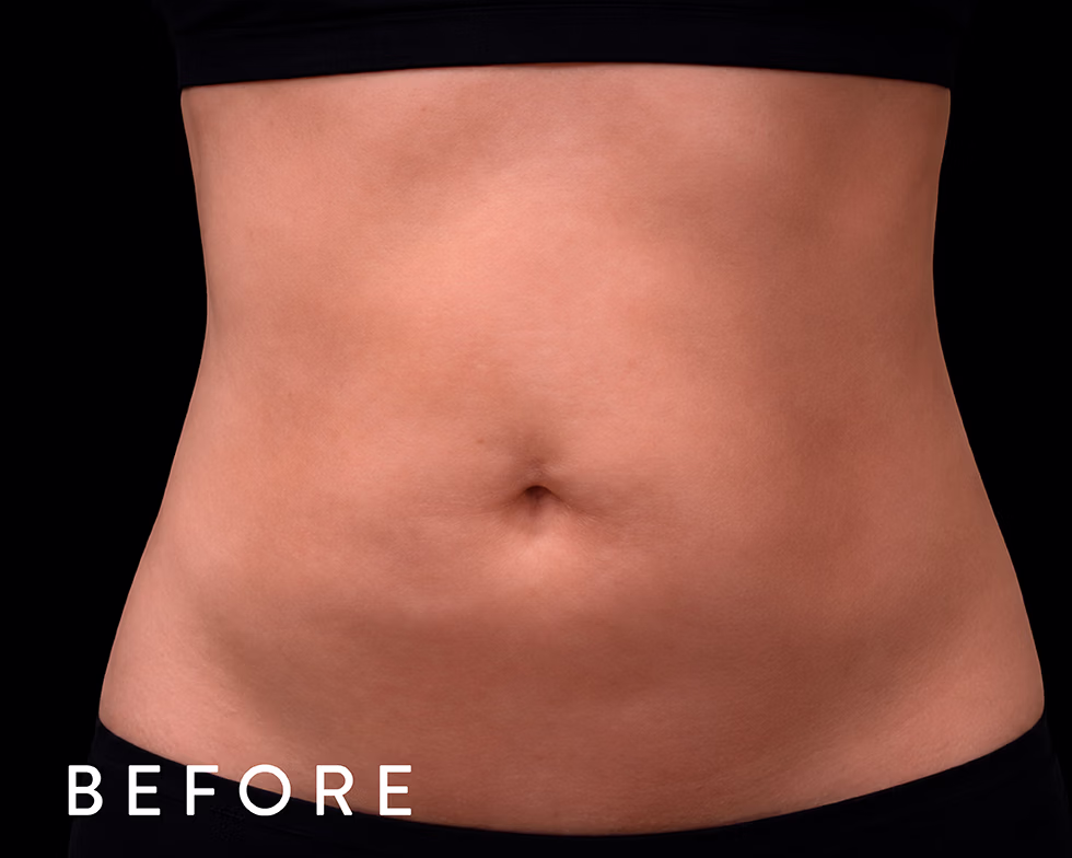 Balmori Center - REDUCIR TALLAS - Ultraformer y Ultherapy - ULTRASONIDO FOCALIZADO DE ALTA INTENSIDAD