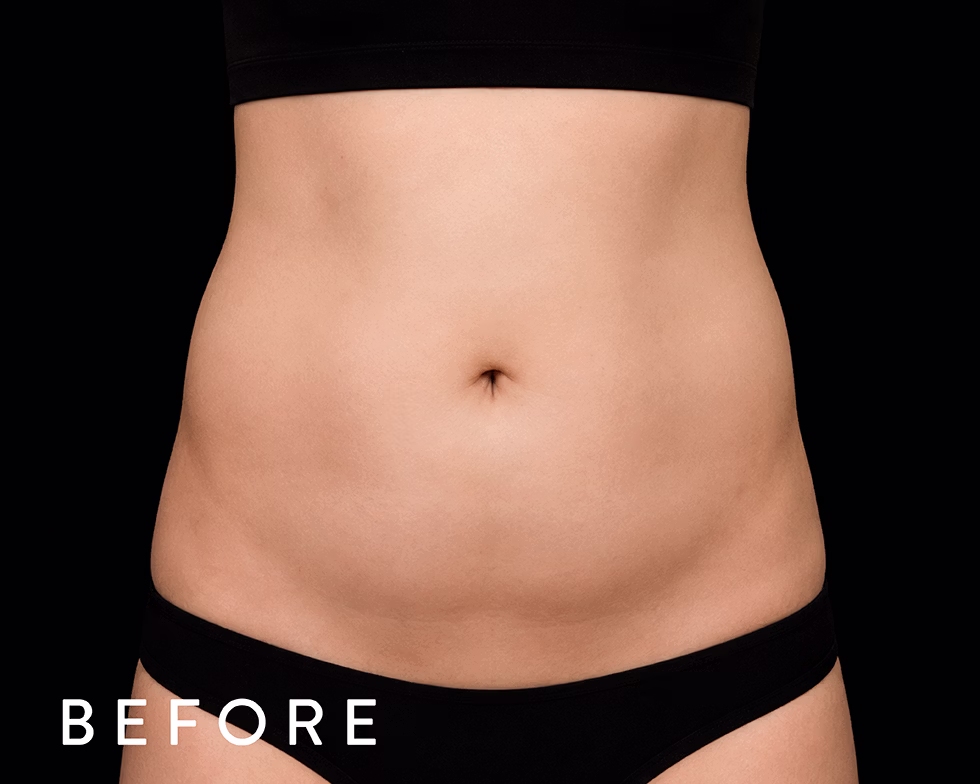 Balmori Center - REDUCIR TALLAS - Ultraformer y Ultherapy - ULTRASONIDO FOCALIZADO DE ALTA INTENSIDAD