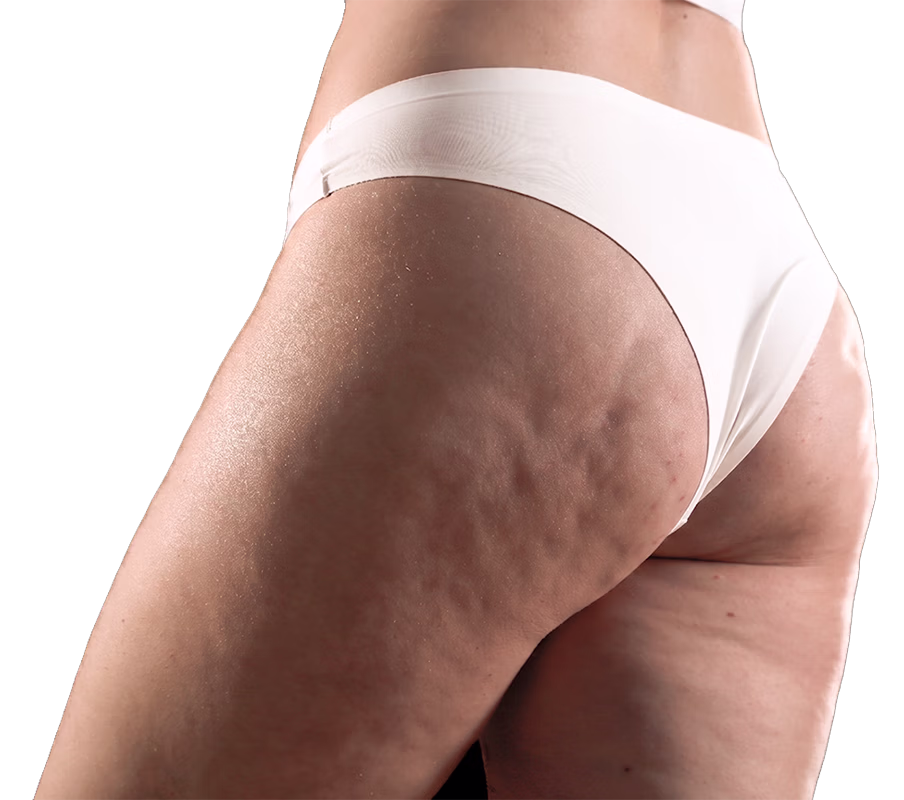 Balmori Center - REDUCIR CELULITIS Y FLACIDEZ BRAZOS, PIERNAS, GLÚTEOS Y ABDOMEN