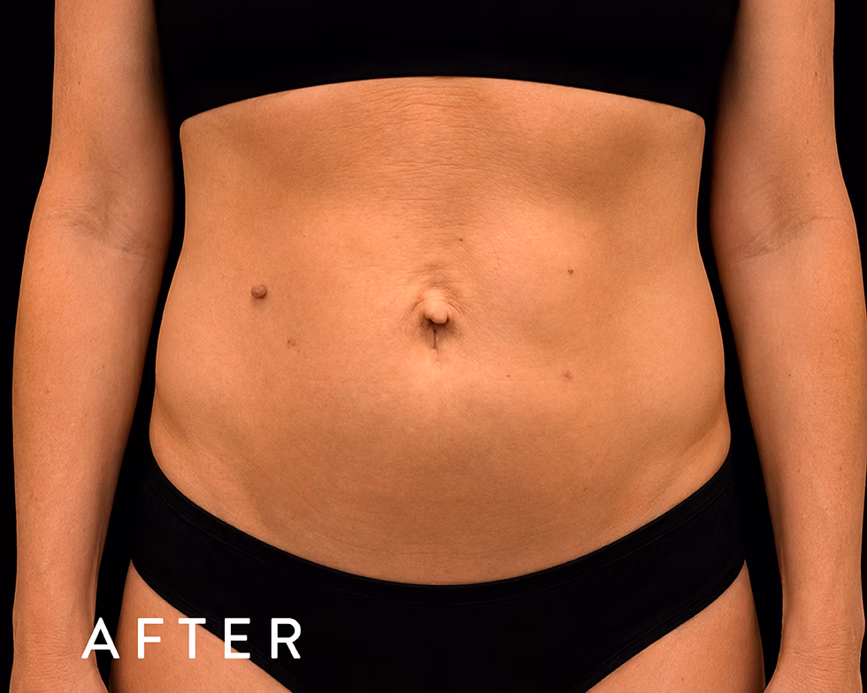 Balmori Center - REDUCIR CELULITIS Y FLACIDEZ BRAZOS, PIERNAS, GLÚTEOS Y ABDOMEN - Ultraformer y Ultherapy - Ultrasonido focalizado de alta intensidad