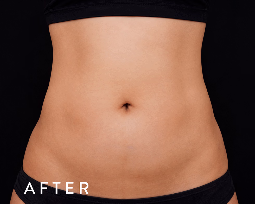 Balmori Center - REDUCIR CELULITIS Y FLACIDEZ BRAZOS, PIERNAS, GLÚTEOS Y ABDOMEN - Ultraformer y Ultherapy - Ultrasonido focalizado de alta intensidad