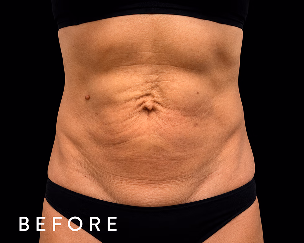 Balmori Center - REDUCIR CELULITIS Y FLACIDEZ BRAZOS, PIERNAS, GLÚTEOS Y ABDOMEN - Ultraformer y Ultherapy - Ultrasonido focalizado de alta intensidad