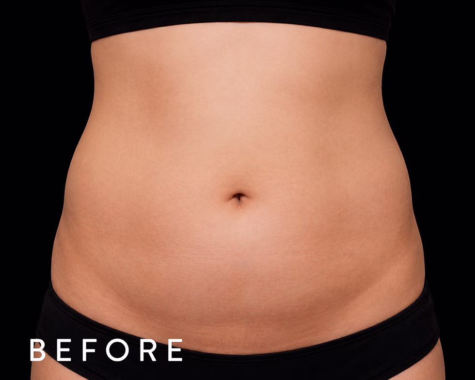 Balmori Center - REDUCIR CELULITIS Y FLACIDEZ BRAZOS, PIERNAS, GLÚTEOS Y ABDOMEN - Ultraformer y Ultherapy - Ultrasonido focalizado de alta intensidad
