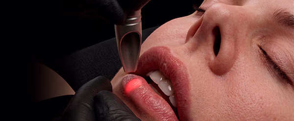 Balmori Center - Servicios - VOLUMEN EN LABIOS